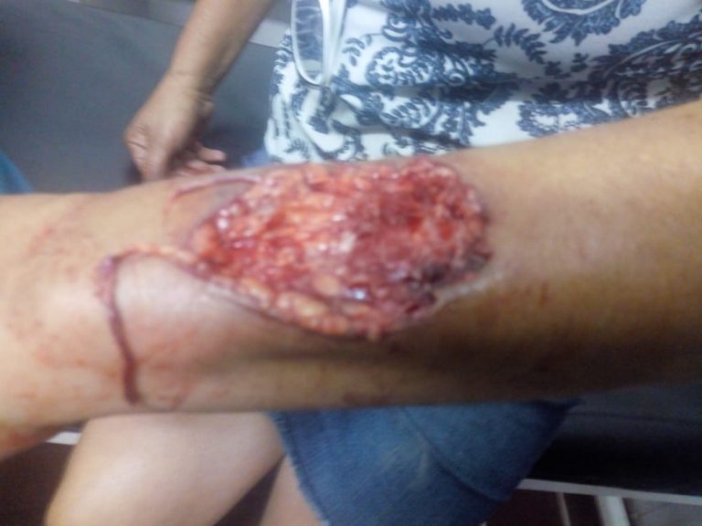 Gravísimo hecho en Quemú: Un Rottweiler le arrancó un pedazo de carne del brazo a una abuela que se interpuso para salvar a su nieto del feroz ataque