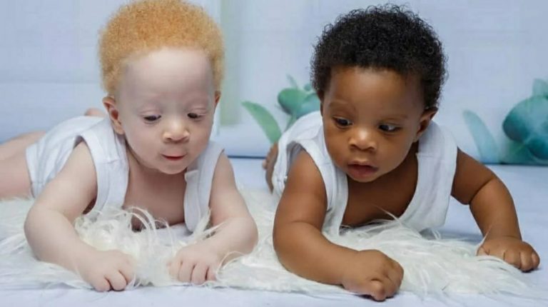 El extraño caso de los mellizos “casi” iguales en Nigeria: uno es negro y el otro albino