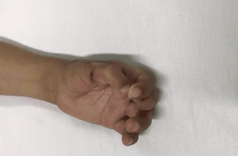 En la Argentina, le trasplantaron con éxito un dedo del pie en la mano a un nene de siete años