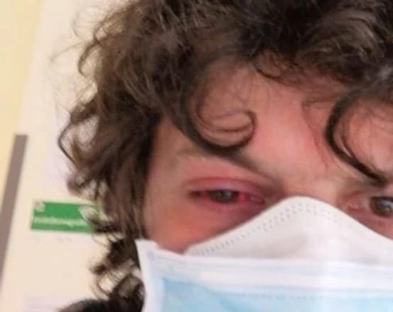 Un pampeano radicado en Italia fue al hospital por una conjuntivitis y le diagnosticaron coronavirus