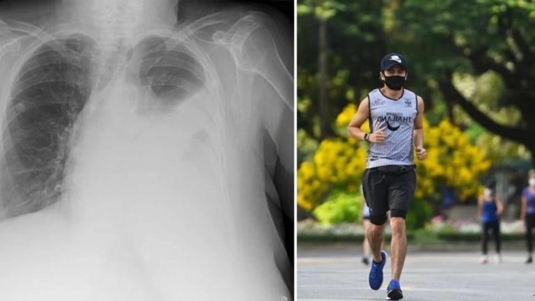 China: «Su pulmón colapsó», la dramática consecuencia que sufrió un joven que salió a correr con barbijo