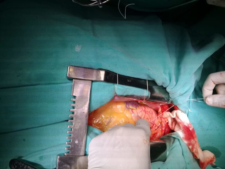 Hace un año realizaban el primer trasplante de tejidos cardíacos en La Pampa