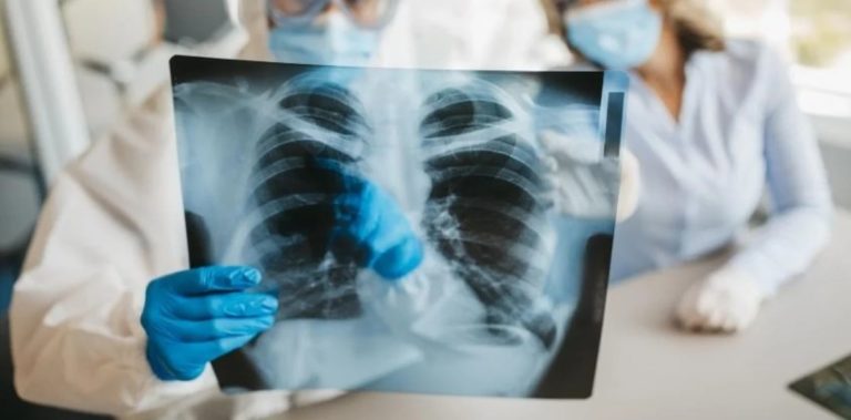 Coronavirus: los pulmones de pacientes con Covid-19 quedan más dañados que los de fumadores