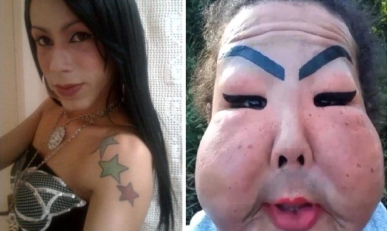 Brasil: “lamento habérmelo puesto”, mujer trans se inyectó silicona industrial en la cara