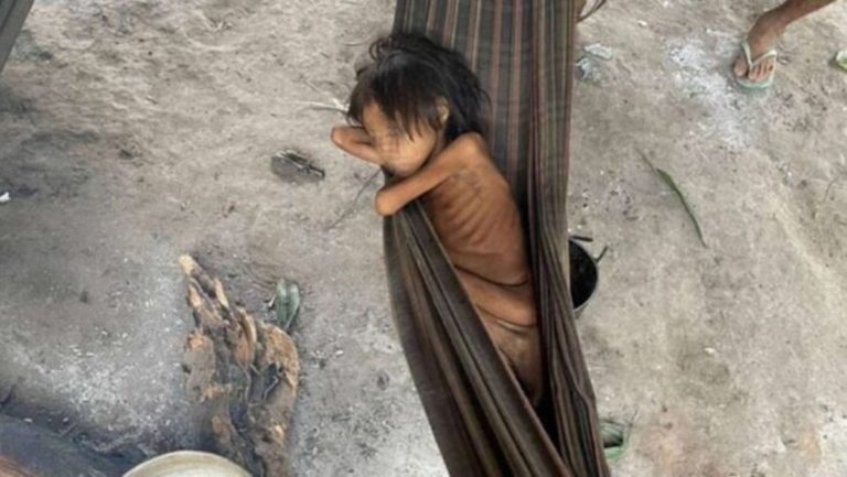 La desgarradora foto de una nena de 8 años de Brasil que pesa 12 kilos que se hizo viral