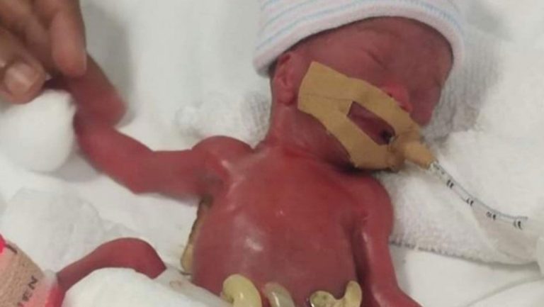 Singapur: luego de un año, dan de alta y se va a su casa la beba prematura “más pequeña del mundo”