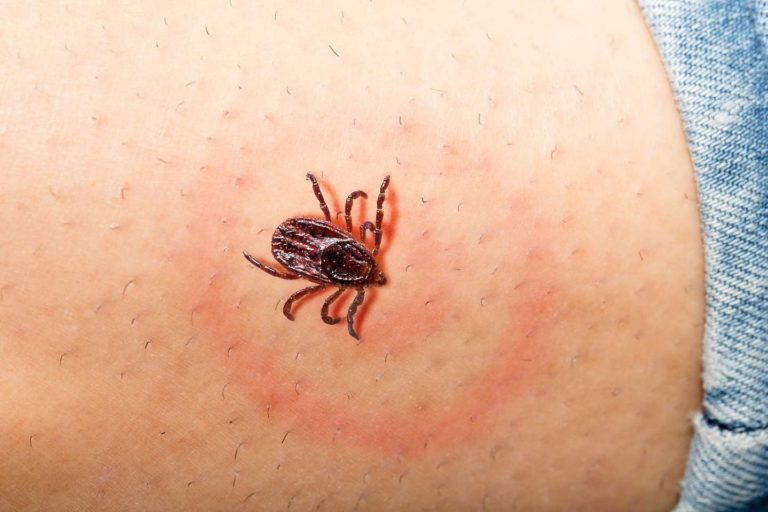 Especialistas creen que Lyme, la enfermedad transmitida por garrapatas, estaría en la Argentina