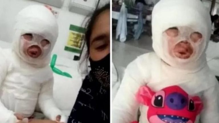 Una nena de tres años fue quemada con aceite hirviendo en un restaurante de Florencio Varela: “Está cada día peor”