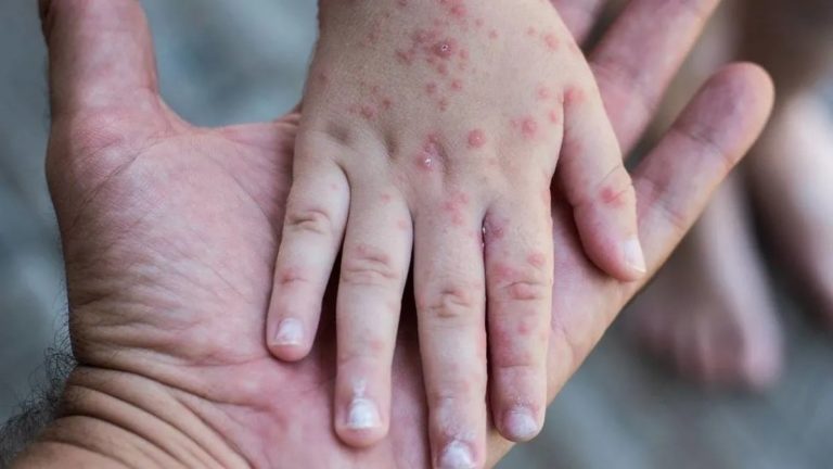 Nación confirma un caso de sarampión y desde el Ministerio de Salud pampeano reafirmaron la importancia de completar los calendarios de vacunación