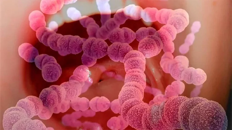 Streptococcus pyogenes: notifican un caso en General Pico