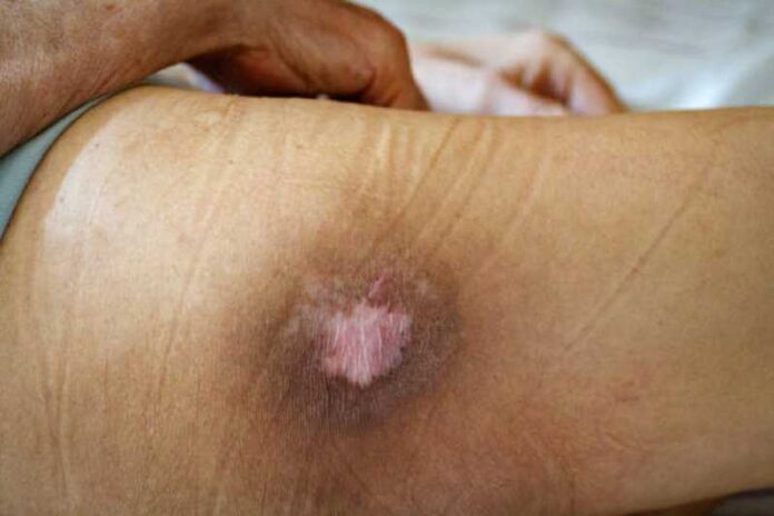 ¿Cómo prevenir las úlceras y escaras por presión en pacientes con poca movilidad?