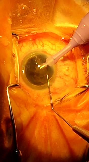 El programa “Visión Pampeana” ya realizó más de 116 operaciones de cataratas de manera totalmente gratuita y junto a un hospital de Cuba, implementará la misma técnica en Córdoba