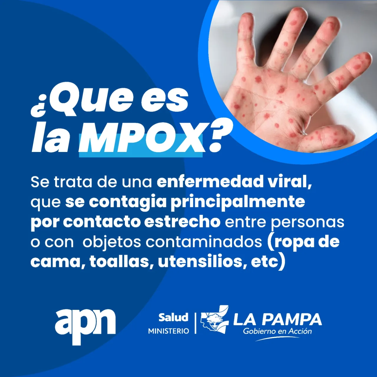 Confirman un caso de Mpox en la provincia con evolución favorable del paciente:  síntomas, prevención y recomendaciones ante la enfermedad viral