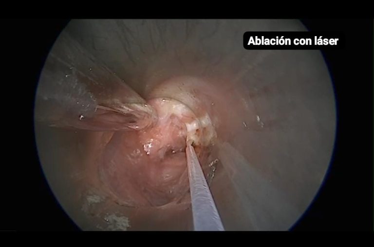 Hito para la Salud Pública pampeana: inédita intervención de alta complejidad
