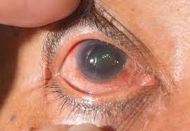 Realizarán una campaña gratuita de detección de glaucoma en General Pico