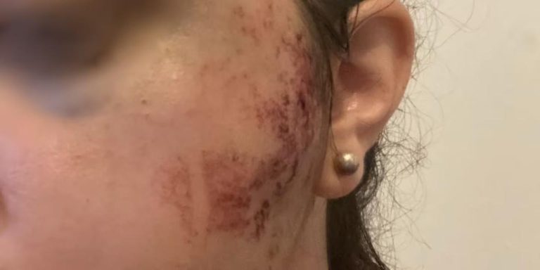 El dramático relato de una joven pampeana que recibió un piedrazo en la cara viajando de Cordoba a Santa Rosa